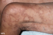 leprosy borderline