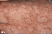 leprosy borderline