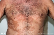 leprosy borderline
