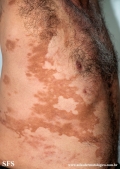 leprosy borderline