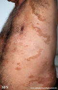 leprosy borderline