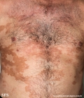 leprosy borderline