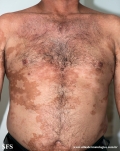 leprosy borderline