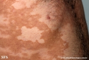 leprosy borderline