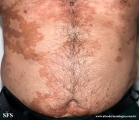 leprosy borderline