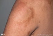 leprosy borderline
