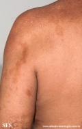 leprosy borderline