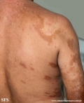 leprosy borderline
