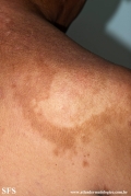 leprosy borderline