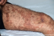 leprosy borderline