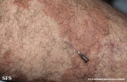 leprosy borderline