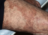 leprosy borderline