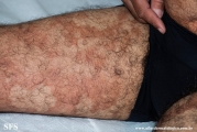 leprosy borderline