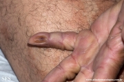 leprosy borderline