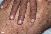 leprosy borderline