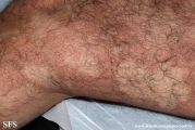 leprosy borderline